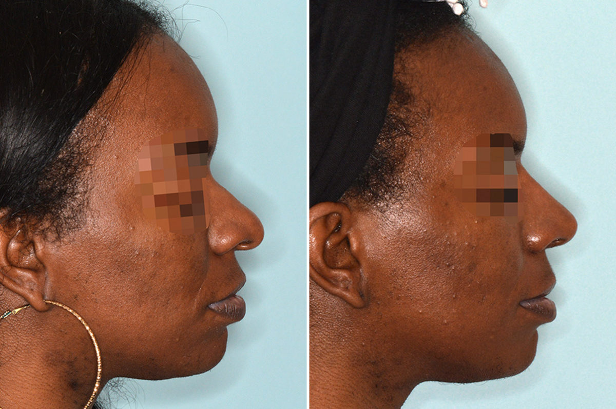 Ethnic Rhinoplasty Before and After Photos in Miami, FL, Patient 3773