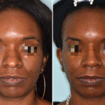 Ethnic Rhinoplasty Before and After Photos in Miami, FL, Patient 3773