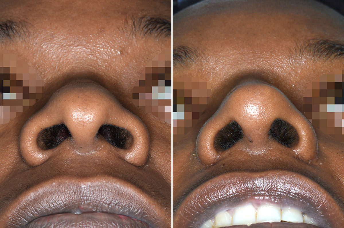 Ethnic Rhinoplasty Before and After Photos in Miami, FL, Patient 3773