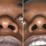 Ethnic Rhinoplasty Before and After Photos in Miami, FL, Patient 3773