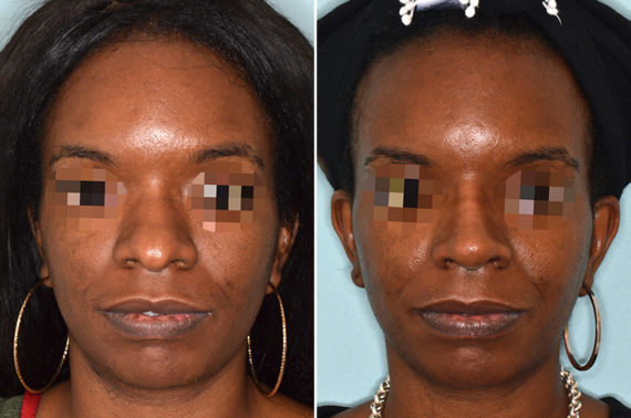 Ethnic Rhinoplasty Before and After Photos in Miami, FL, Patient 3773