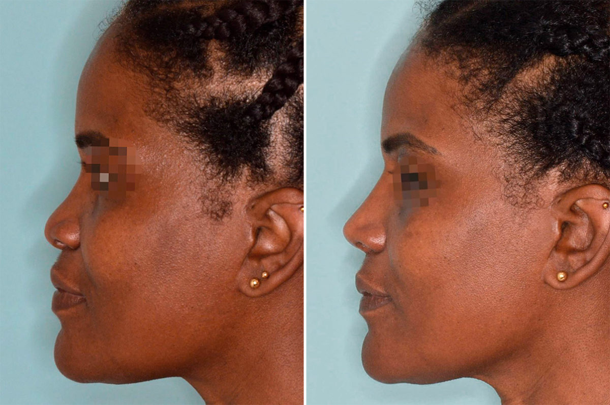 Ethnic Rhinoplasty Before and After Photos in Miami, FL, Patient 4612