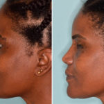 Ethnic Rhinoplasty Before and After Photos in Miami, FL, Patient 4612