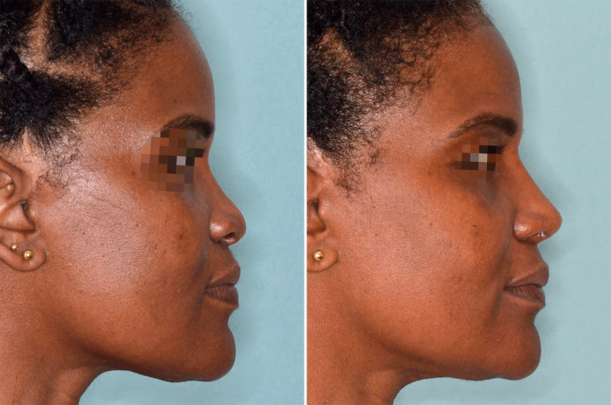 Ethnic Rhinoplasty Before and After Photos in Miami, FL, Patient 4612