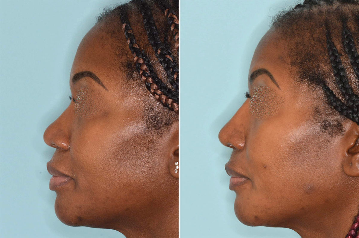 Ethnic Rhinoplasty Before and After Photos in Miami, FL, Patient 5018