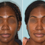 Ethnic Rhinoplasty Before and After Photos in Miami, FL, Patient 5018