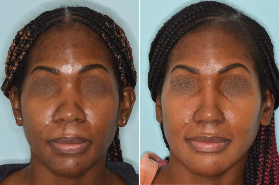 Ethnic Rhinoplasty Before and After Photos in Miami, FL, Patient 5018