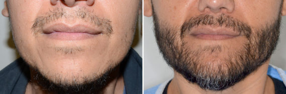 Beard Transplant Before and After Photos in Miami, FL, Patient 6392