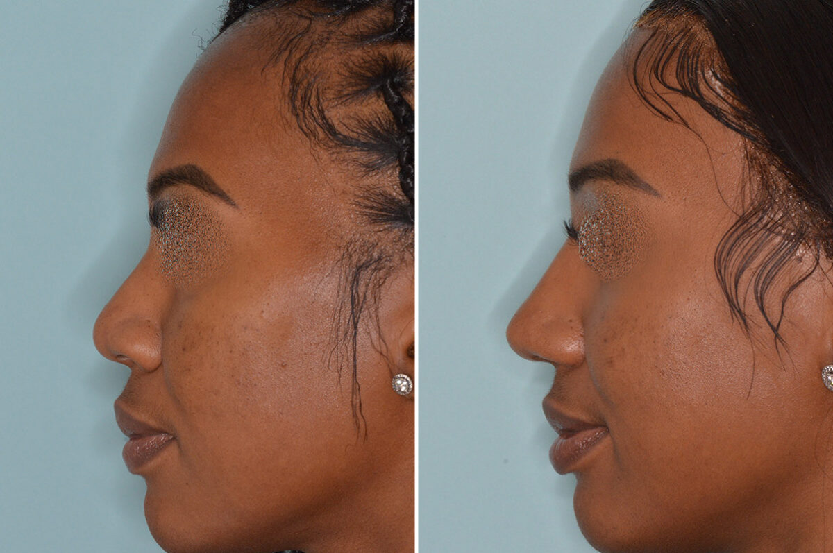 Ethnic Rhinoplasty Before and After Photos in Miami, FL, Patient 6454