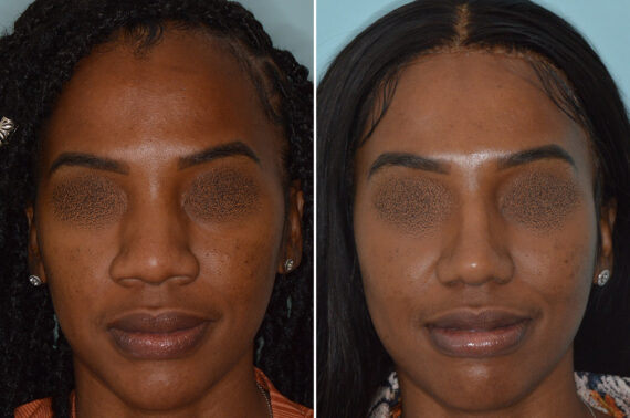 Ethnic Rhinoplasty Before and After Photos in Miami, FL, Patient 6454