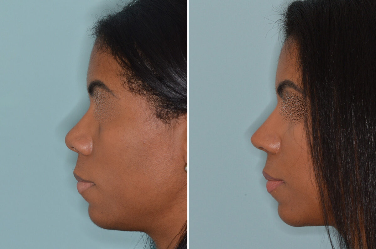 Ethnic Rhinoplasty Before and After Photos in Miami, FL, Patient 6485