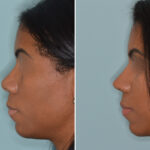 Ethnic Rhinoplasty Before and After Photos in Miami, FL, Patient 6485