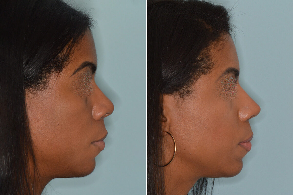 Ethnic Rhinoplasty Before and After Photos in Miami, FL, Patient 6485