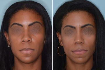 Ethnic Rhinoplasty Before and After Photos in Miami, FL, Patient 6485