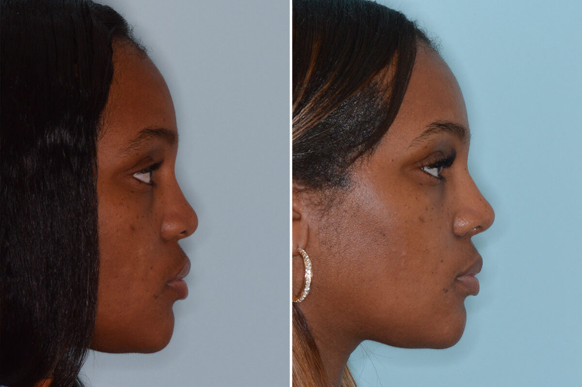 Ethnic Rhinoplasty Before and After Photos in Miami, FL, Patient 6495