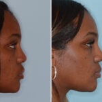 Ethnic Rhinoplasty Before and After Photos in Miami, FL, Patient 6495