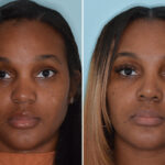 Ethnic Rhinoplasty Before and After Photos in Miami, FL, Patient 6495