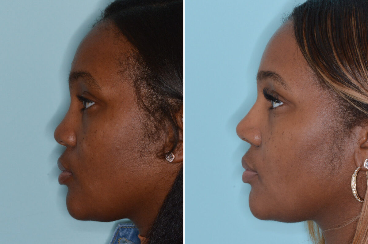 Ethnic Rhinoplasty Before and After Photos in Miami, FL, Patient 6495