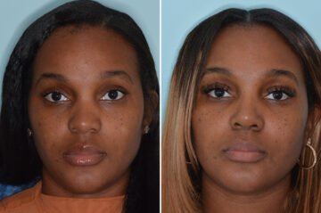 Ethnic Rhinoplasty Before and After Photos in Miami, FL, Patient 6495