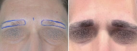 Hair Restoration Before and After Photos in Miami, FL, Patient 6578