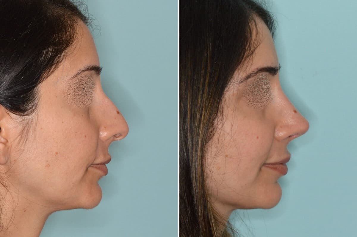 Rhinoplasty Before and After Photos in Miami, FL, Patient 6592