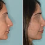 Rhinoplasty Before and After Photos in Miami, FL, Patient 6592