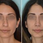 Rhinoplasty Before and After Photos in Miami, FL, Patient 6592