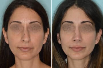 Rhinoplasty Before and After Photos in Miami, FL, Patient 6592