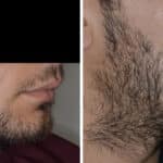 Beard Transplant Before and After Photos in Miami, FL, Patient 2721