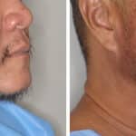 Beard Transplant Before and After Photos in Miami, FL, Patient 2757