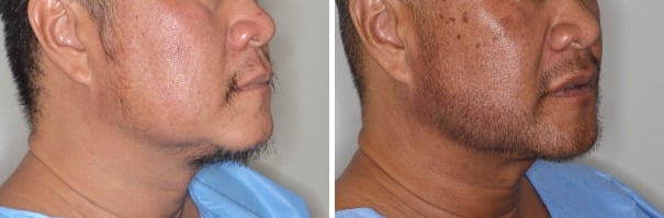 Beard Transplant Before and After Photos in Miami, FL, Patient 2757