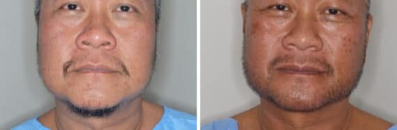 Beard Transplant Before and After Photos in Miami, FL, Patient 2757