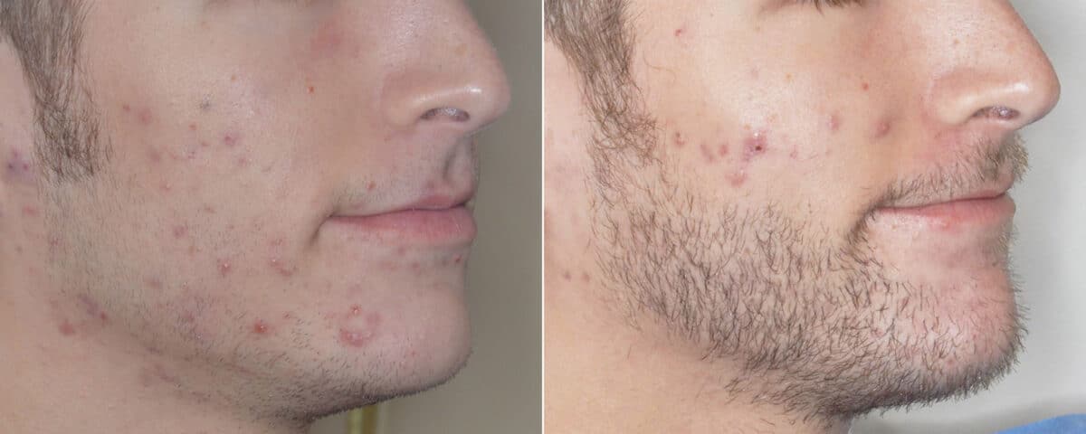 Beard Transplant Before and After Photos in Miami, FL, Patient 3012