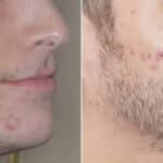 Beard Transplant Before and After Photos in Miami, FL, Patient 3012