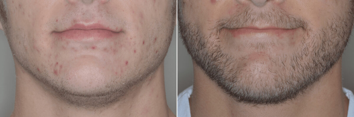 Beard Transplant Before and After Photos in Miami, FL, Patient 3012