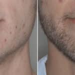 Beard Transplant Before and After Photos in Miami, FL, Patient 3012