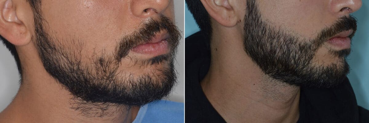 Beard Transplant Before and After Photos in Miami, FL, Patient 3272