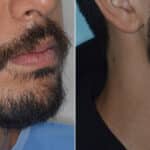 Beard Transplant Before and After Photos in Miami, FL, Patient 3272