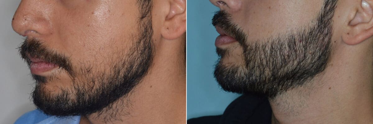 Beard Transplant Before and After Photos in Miami, FL, Patient 3272