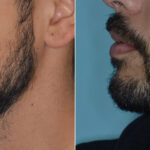 Beard Transplant Before and After Photos in Miami, FL, Patient 3272