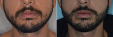 Beard Transplant Before and After Photos in Miami, FL, Patient 3272