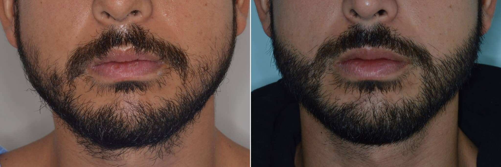 Beard Transplant Photos Dr. Anthony Bared, M.D Facial Plastic Surgeon