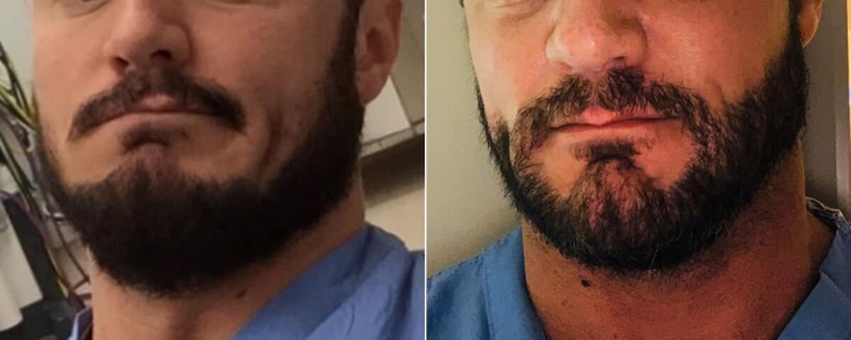 Beard Transplant Before and After Photos in Miami, FL, Patient 3440