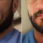 Beard Transplant Before and After Photos in Miami, FL, Patient 3440