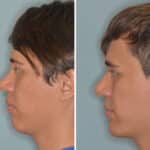 Revision Rhinoplasty Before and After Photos in Miami, FL, Patient 920