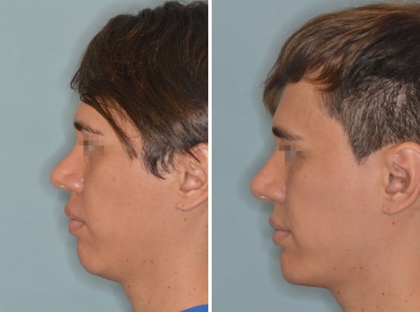 Revision Rhinoplasty Before and After Photos in Miami, FL, Patient 920