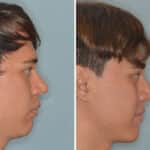 Revision Rhinoplasty Before and After Photos in Miami, FL, Patient 920