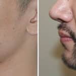 Beard Transplant Before and After Photos in Miami, FL, Patient 6723