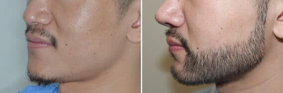 Beard Transplant Before and After Photos in Miami, FL, Patient 6723