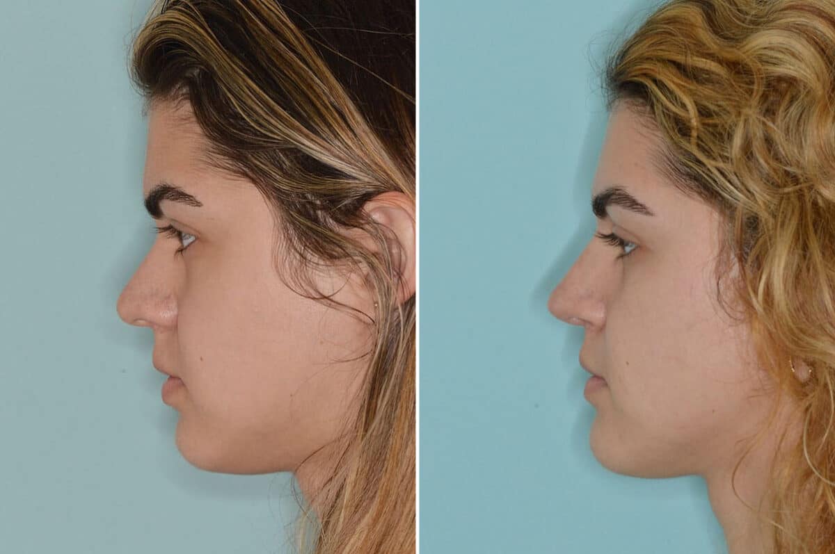 Rhinoplasty Before and After Photos in Miami, FL, Patient 6744